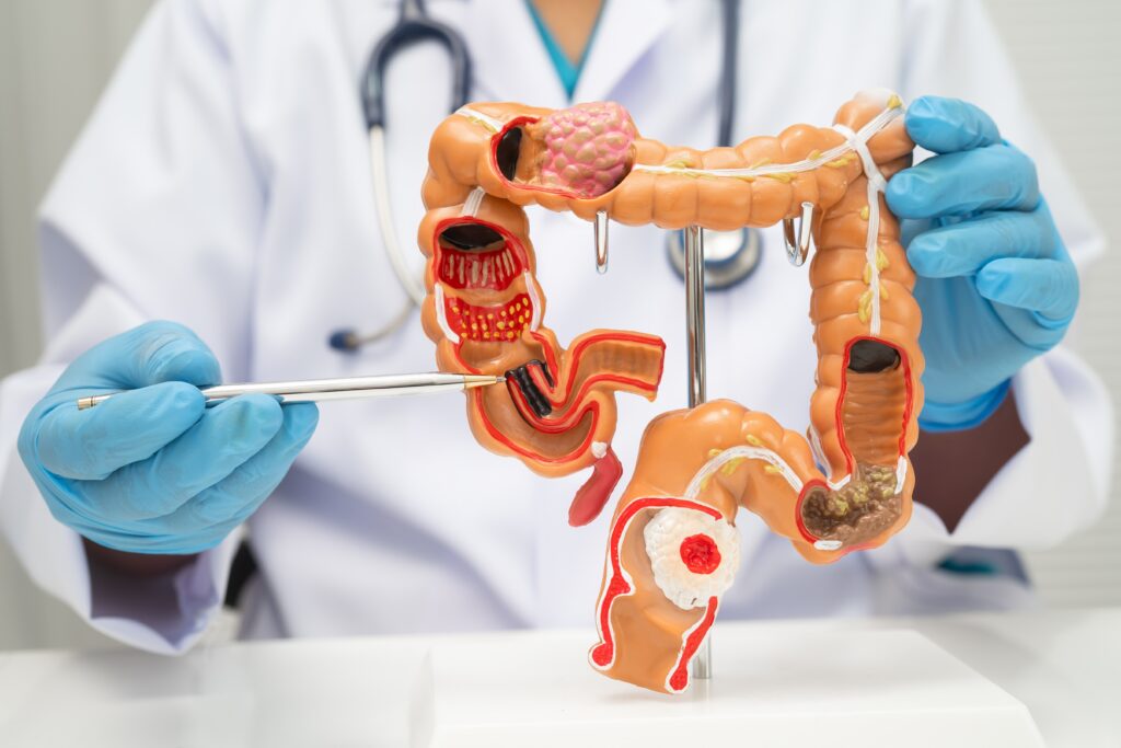 Polyp Removal To Prevent Cancer | Melbourne Colonoscopy Specialist | Female Colorectal Surgeon
