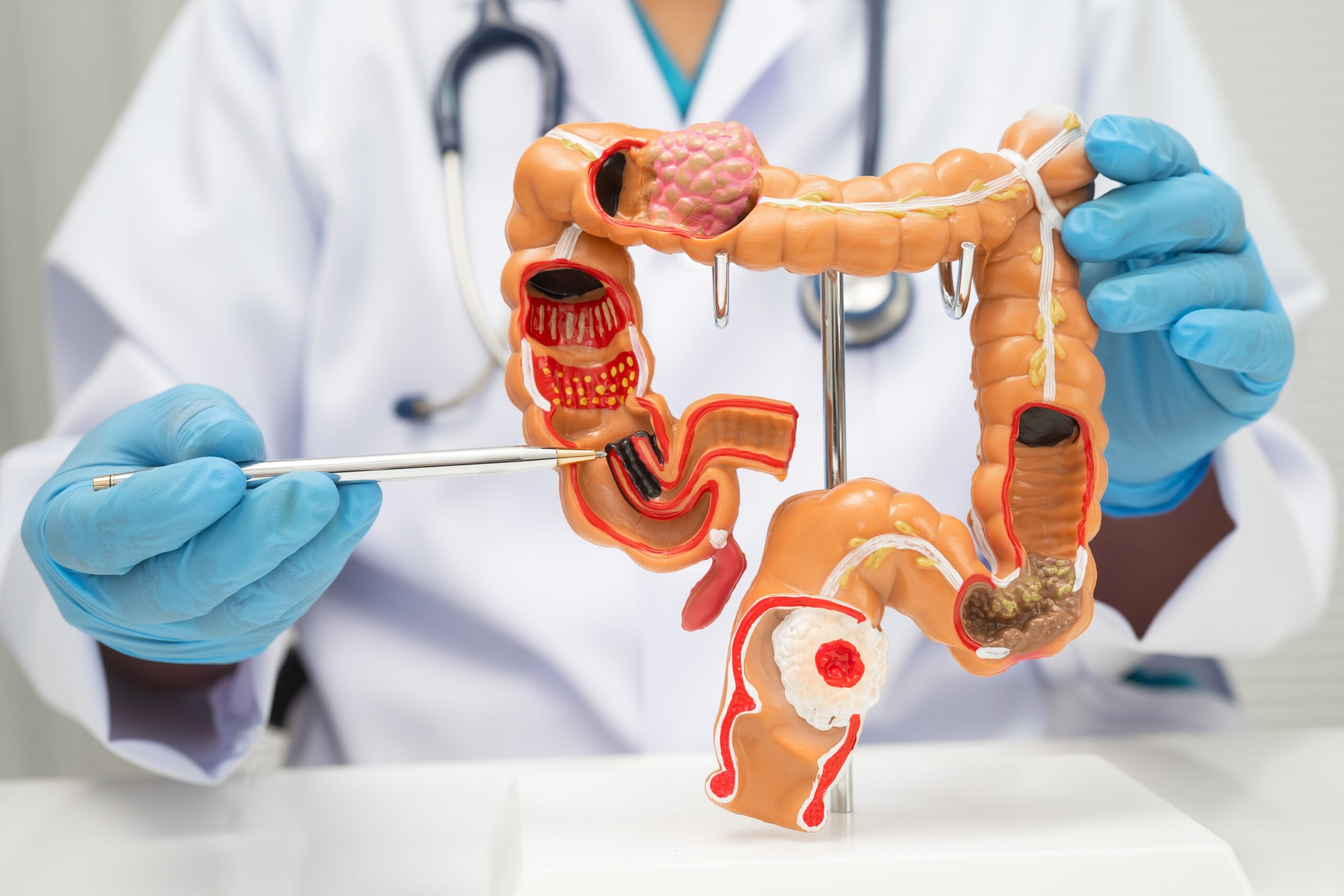 Polyp Removal To Prevent Cancer | Melbourne Colonoscopy Specialist | Female Colorectal Surgeon