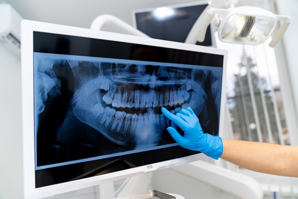 Dental X-Ray Safety | Family Dentist In Darwin | Radiation Safety For Patients